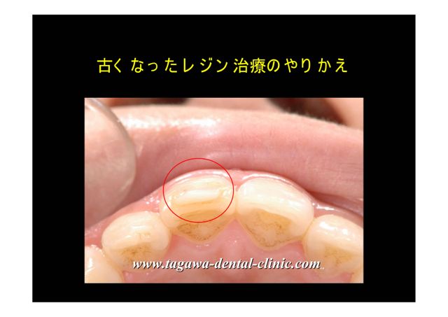 レジンと歯の境目に生じた不適合部分の拡大写真